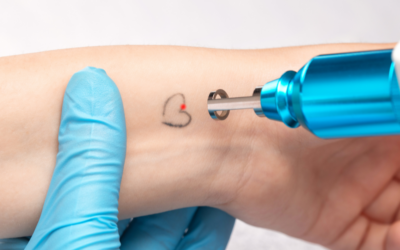 Overview of Tattoo Removal Methods and Associated Risks