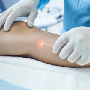 Laser Vein Removal Consent Template